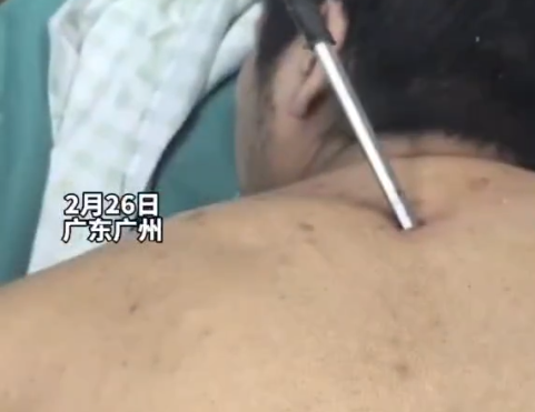 高空掉落30cm螺丝刀直插男子胸腔 切记不要自行拔除异物